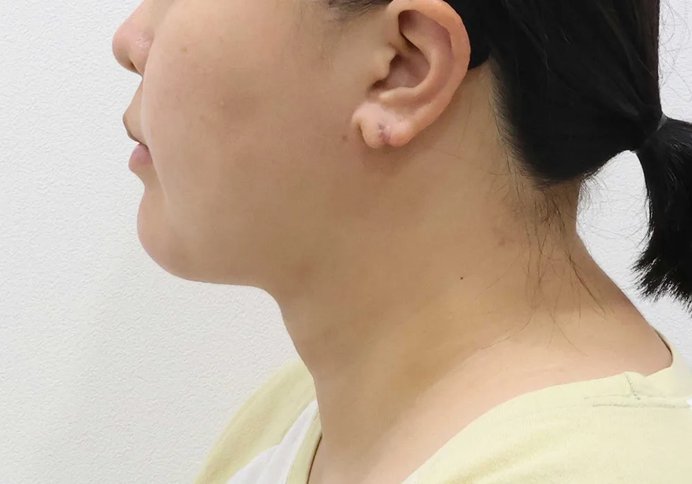 Thời điểm theo dõi — cắt mỡ Bichat kèm hút mỡ mặt, hút mỡ nọng cằm và siết cơ platysma
