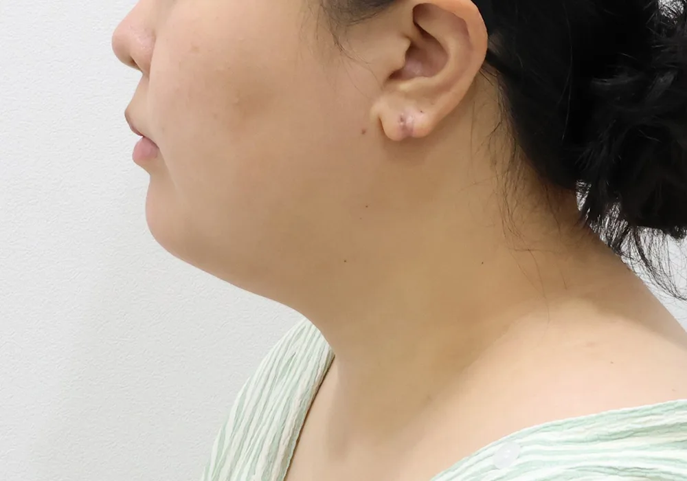 Thời điểm ban đầu — cắt mỡ Bichat kèm hút mỡ mặt, hút mỡ nọng cằm và siết cơ platysma