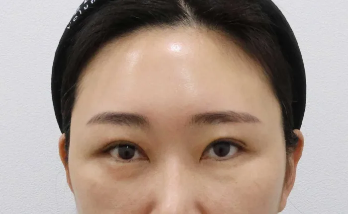 Después de un lifting de cejas aislado en Rewind Plastic Surgery