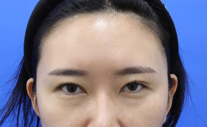 Antes de un lifting de cejas aislado en Rewind Plastic Surgery