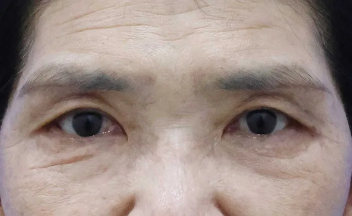 Después de una blefaroplastia subcejas aislada en Rewind Plastic Surgery