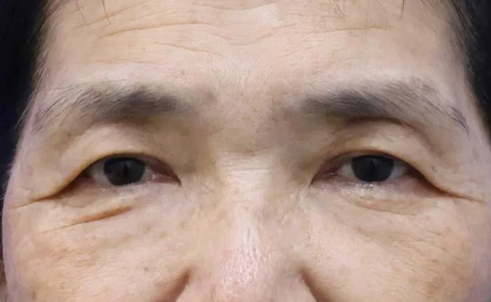 Antes de una blefaroplastia subcejas aislada en Rewind Plastic Surgery