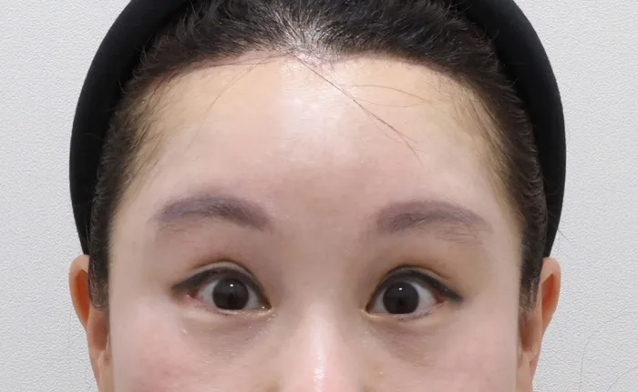 Después de un lifting de cejas con reducción de frente, liposucción de papada, tensado del platisma y extracción de grasa subplatismal