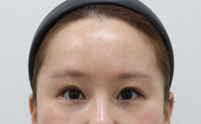 Antes de un lifting de cejas con reducción de frente, liposucción de papada, tensado del platisma y extracción de grasa subplatismal