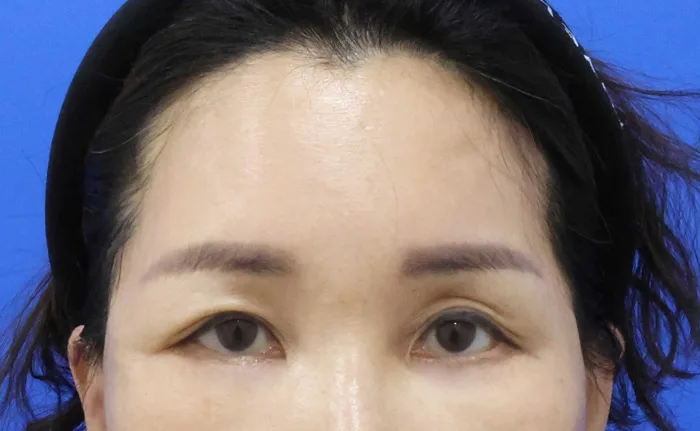 Después de un lifting de cejas con lifting facial parcial y reposición de grasa bajo los ojos, de la frente a los ojos