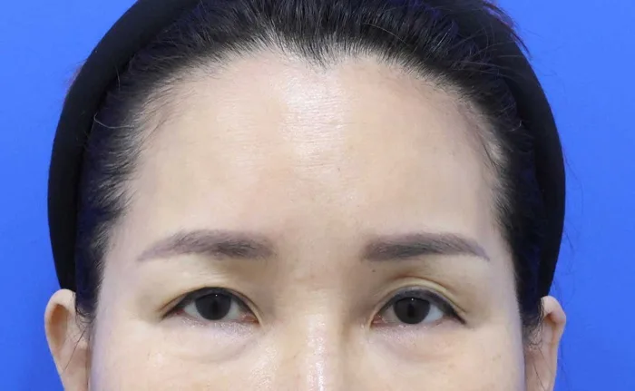 Antes de un lifting de cejas con lifting facial parcial y reposición de grasa bajo los ojos, de la frente a los ojos