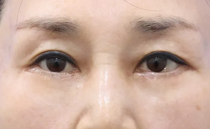 Después de una blefaroplastia subcejas con cirugía de párpado inferior en la misma sesión