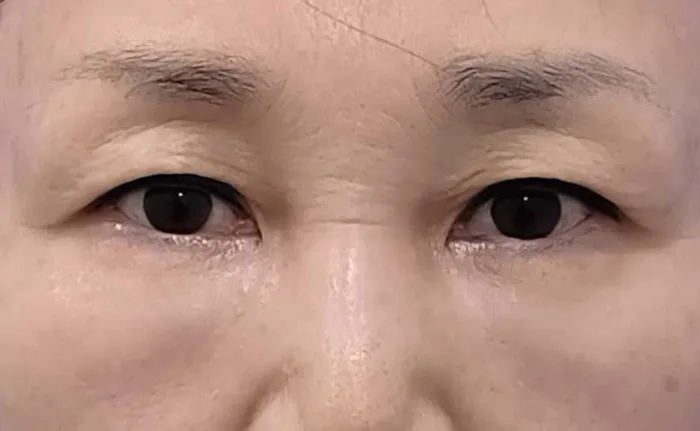 Antes de una blefaroplastia subcejas con cirugía de párpado inferior en la misma sesión