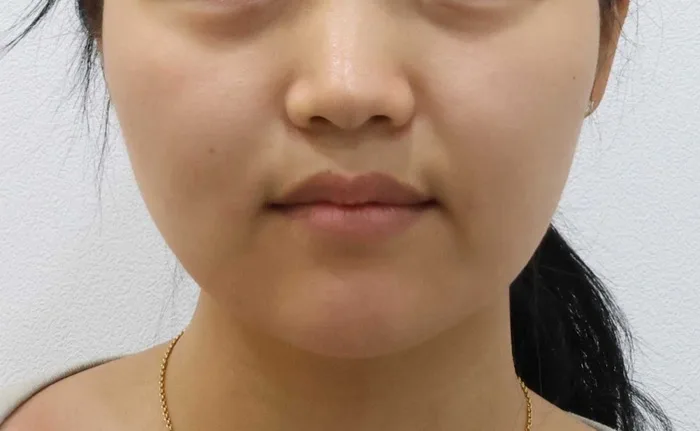Thời điểm theo dõi — cắt mỡ Bichat thực hiện đơn lẻ tại Rewind Plastic Surgery