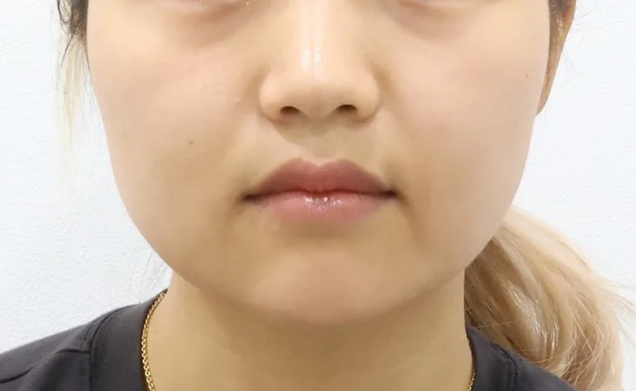 Thời điểm ban đầu — cắt mỡ Bichat thực hiện đơn lẻ tại Rewind Plastic Surgery
