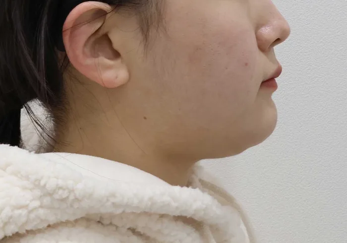 Thời điểm ban đầu — cắt mỡ Bichat kèm hút mỡ nọng cằm và siết cơ platysma