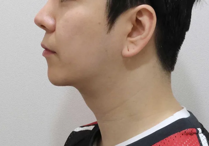 Perfil posterior: extracción de grasa subplatismal con liposucción de papada y línea mandibular y tensado del platisma, paciente masculino