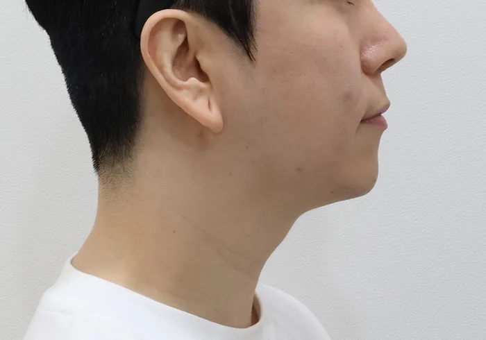 Perfil previo: extracción de grasa subplatismal con liposucción de papada y línea mandibular y tensado del platisma, paciente masculino