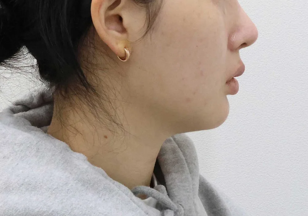 Ảnh chụp góc nghiêng ca hút mỡ viền hàm và nọng cằm kèm buộc cơ, thời điểm ban đầu