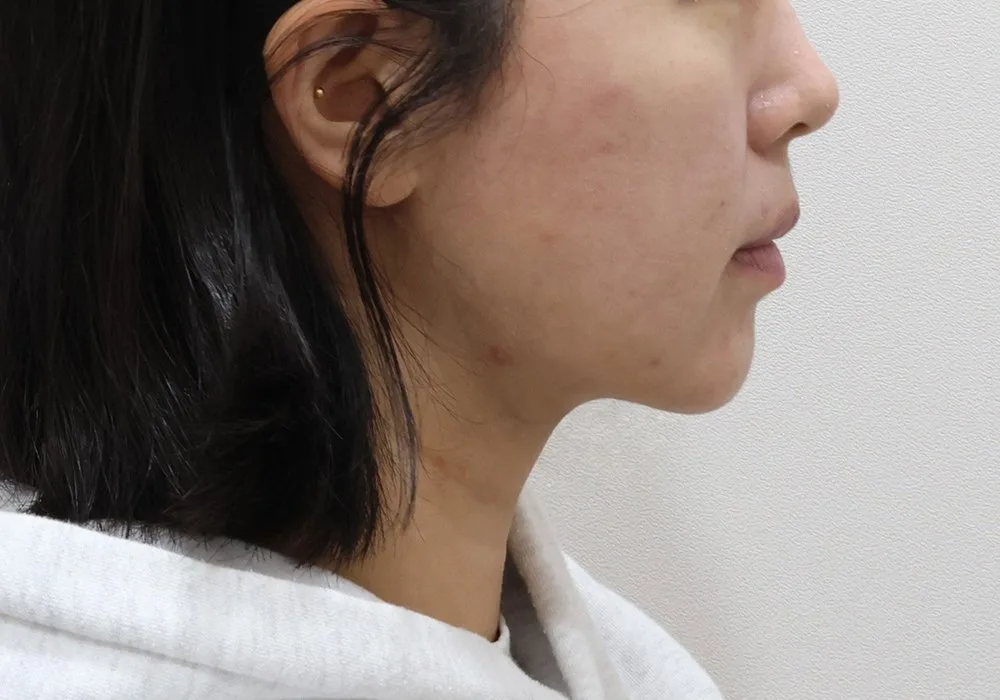 Ảnh chụp góc nghiêng ca hút mỡ nọng cằm kèm buộc cơ và lấy mỡ sâu dưới cơ, thời điểm theo dõi