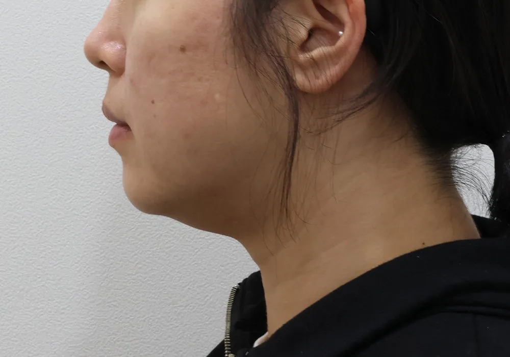 Ảnh chụp góc nghiêng ca hút mỡ nọng cằm kèm buộc cơ và lấy mỡ sâu dưới cơ, thời điểm ban đầu