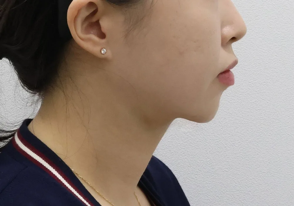 Ảnh chụp góc nghiêng ca hút mỡ nọng cằm kèm buộc cơ sâu và lấy mỡ dưới cơ, thời điểm theo dõi