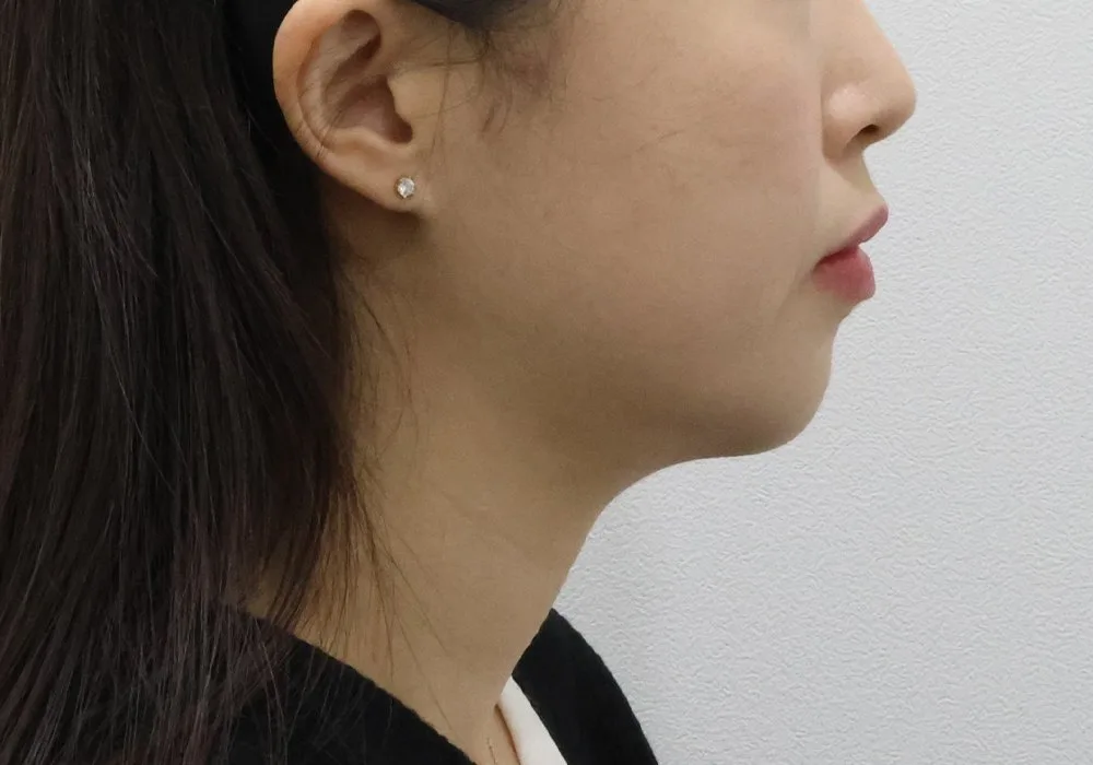 Ảnh chụp góc nghiêng ca hút mỡ nọng cằm kèm buộc cơ sâu và lấy mỡ dưới cơ, thời điểm ban đầu