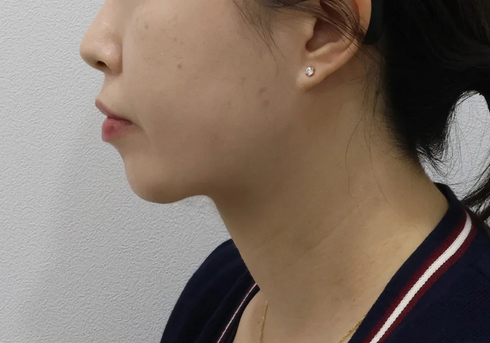 Perfil posterior: extracción de grasa subplatismal con liposucción de papada y tensado profundo del platisma