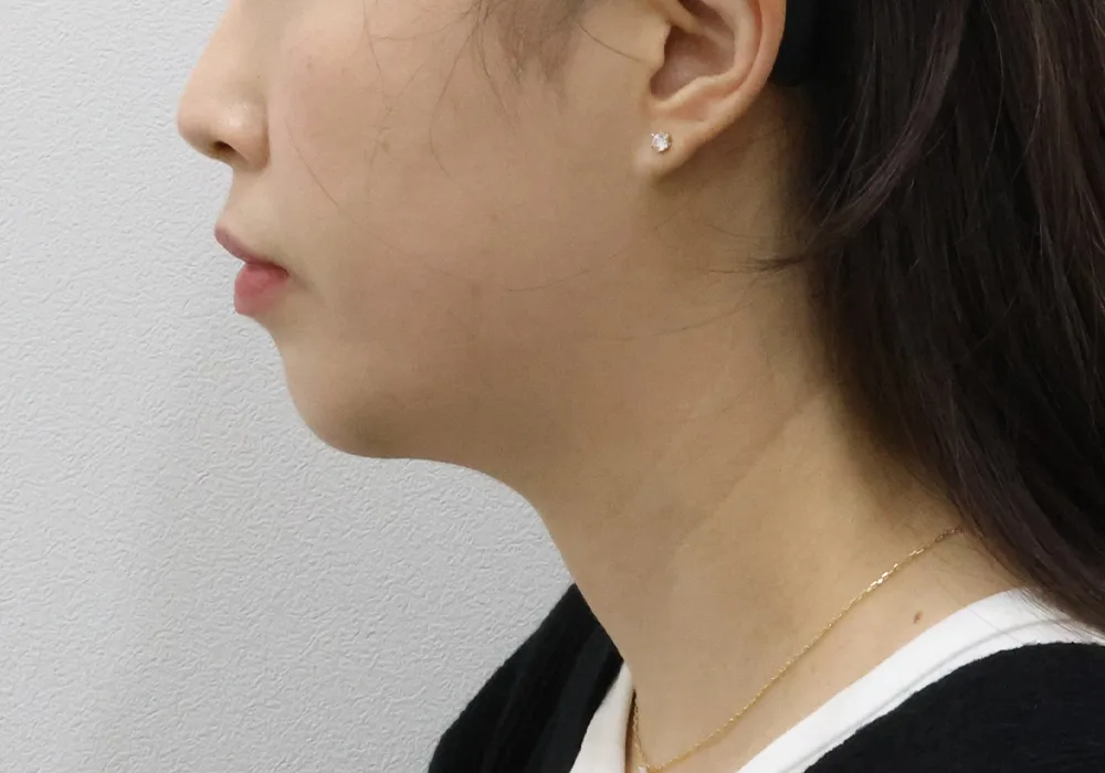 Perfil previo: extracción de grasa subplatismal con liposucción de papada y tensado profundo del platisma