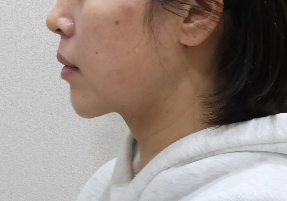 After &mdash; chin liposuction with platysma tightening and subplatysmal fat removal