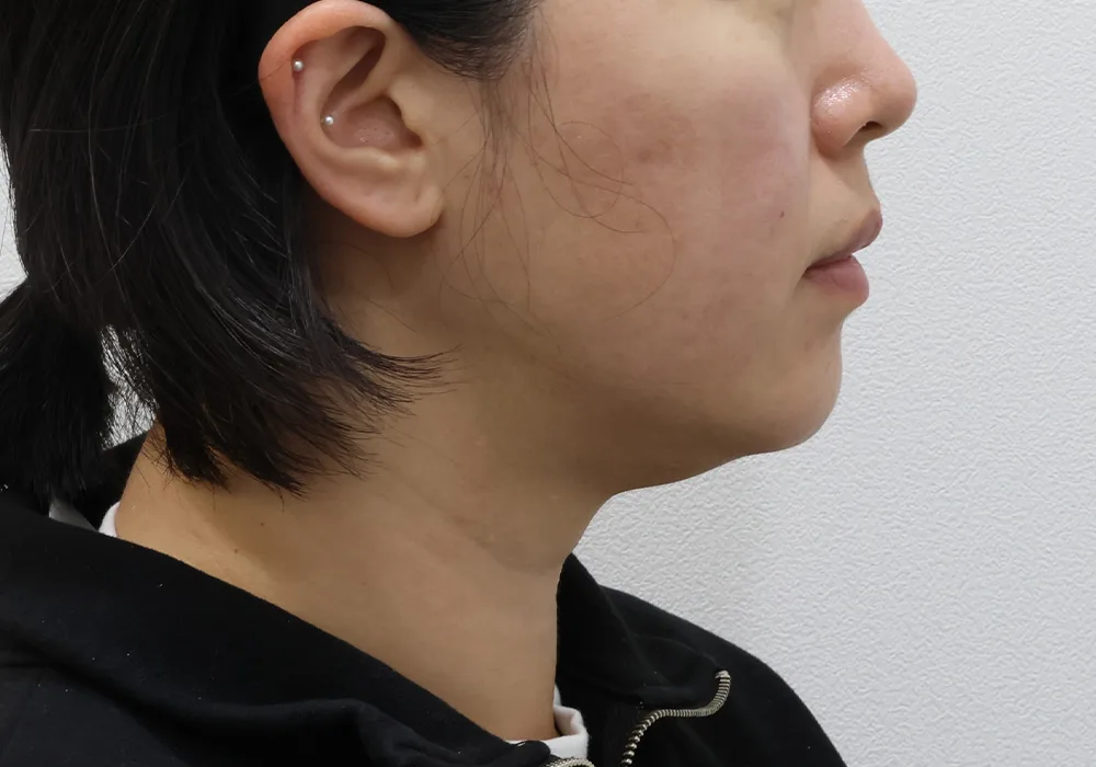 Before &mdash; chin liposuction with platysma tightening and subplatysmal fat removal