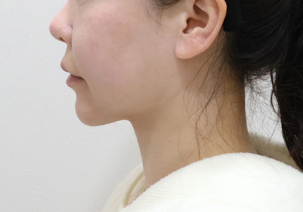 Perfil posterior: extracción de grasa subplatismal con liposucción de papada, tensado del platisma y lifting con reducción de frente
