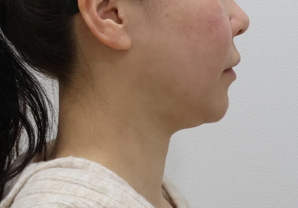 Perfil previo: extracción de grasa subplatismal con liposucción de papada, tensado del platisma y lifting con reducción de frente