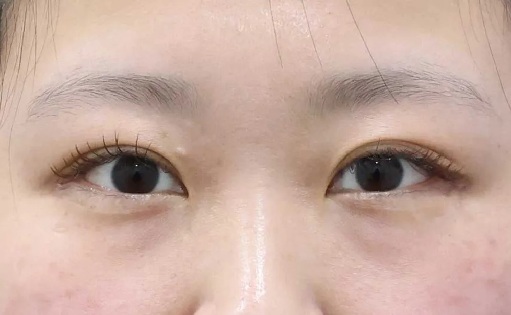 Después de una epicantoplastia medial aislada en Rewind Plastic Surgery