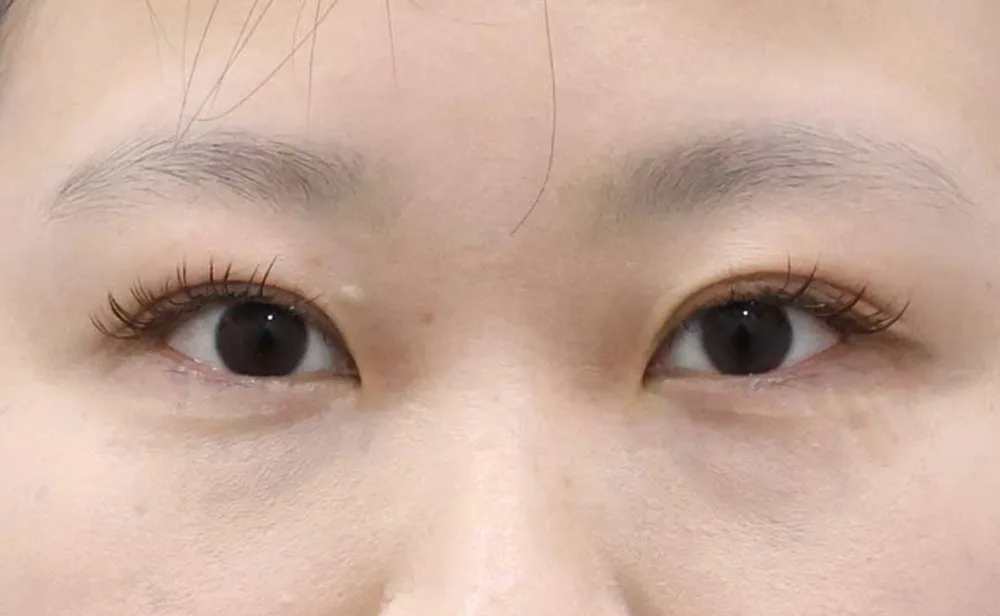 Antes de una epicantoplastia medial aislada en Rewind Plastic Surgery