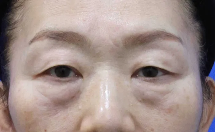 Thời điểm ban đầu — tái bố trí mỡ bọng mắt kèm cắt da thừa mí trên
