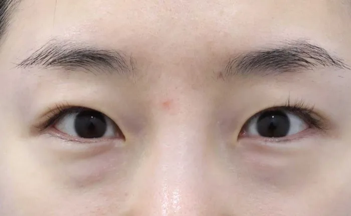 Antes de una epicantoplastia medial con pliegue sin incisión y reposición de grasa bajo los ojos