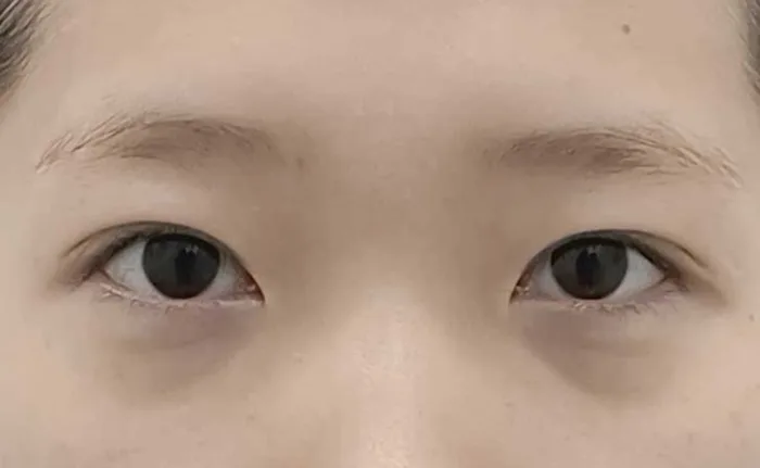 Trước khi tiêm filler rãnh lệ, góc chính diện