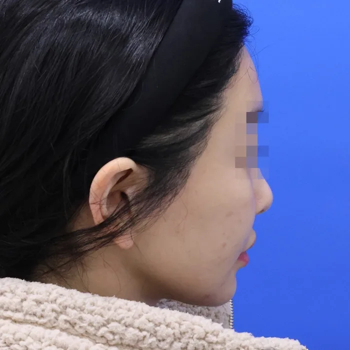 Trước khi tiêm filler vùng trán, góc nghiêng