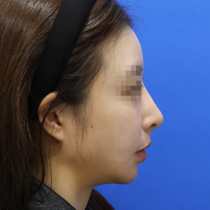 Sau khi tiêm filler sống mũi, góc nghiêng