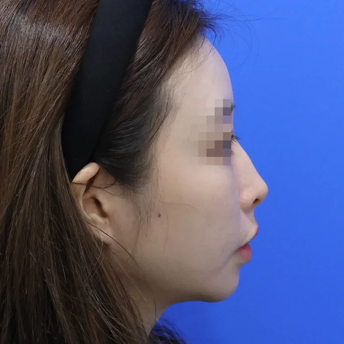 Trước khi tiêm filler sống mũi, góc nghiêng
