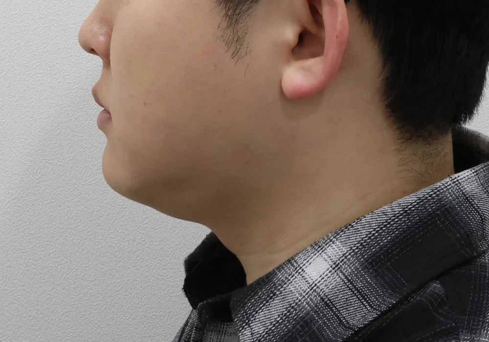 Thời điểm ban đầu — hút mỡ má và nọng cằm kèm xử lý cơ platysma sâu và cắt mỡ Bichat