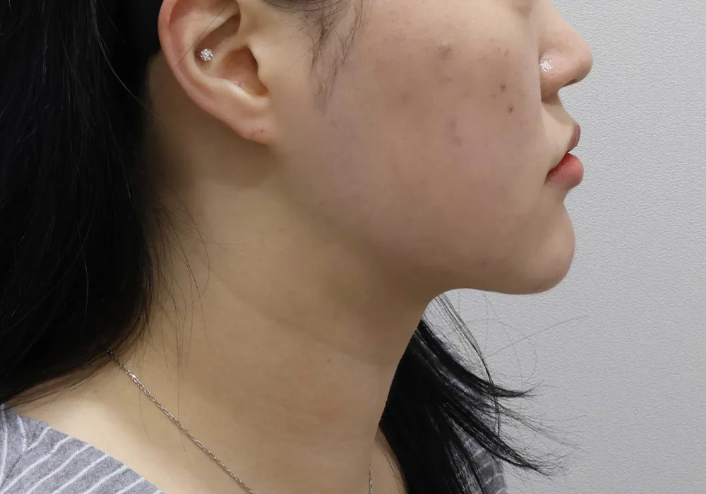 Thời điểm theo dõi — hút mỡ má kèm hút mỡ nọng cằm và siết cơ platysma