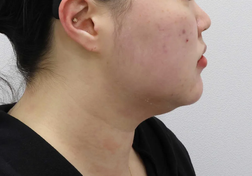 Thời điểm ban đầu — hút mỡ má kèm hút mỡ nọng cằm và siết cơ platysma