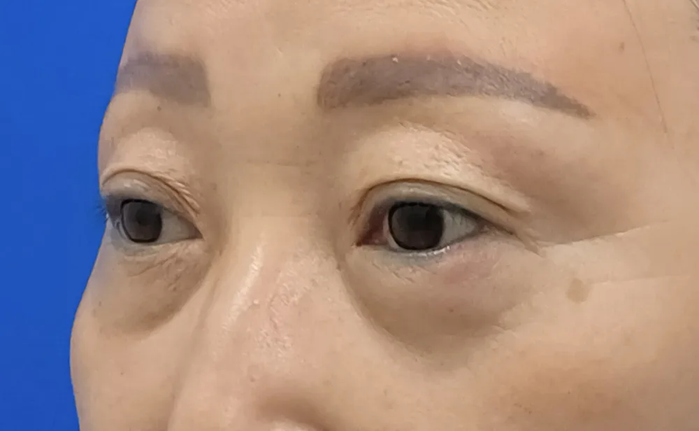 Thời điểm ban đầu — tái bố trí mỡ bọng mắt, góc chụp sắc chéo