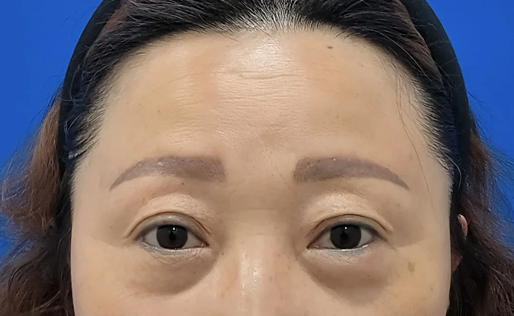 Thời điểm ban đầu — tái bố trí mỡ cho bọng mắt lồi, góc chụp chính diện