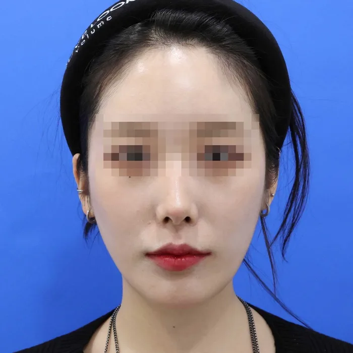 Sau điều trị — căng chỉ cố định lớp cân, ảnh chính diện