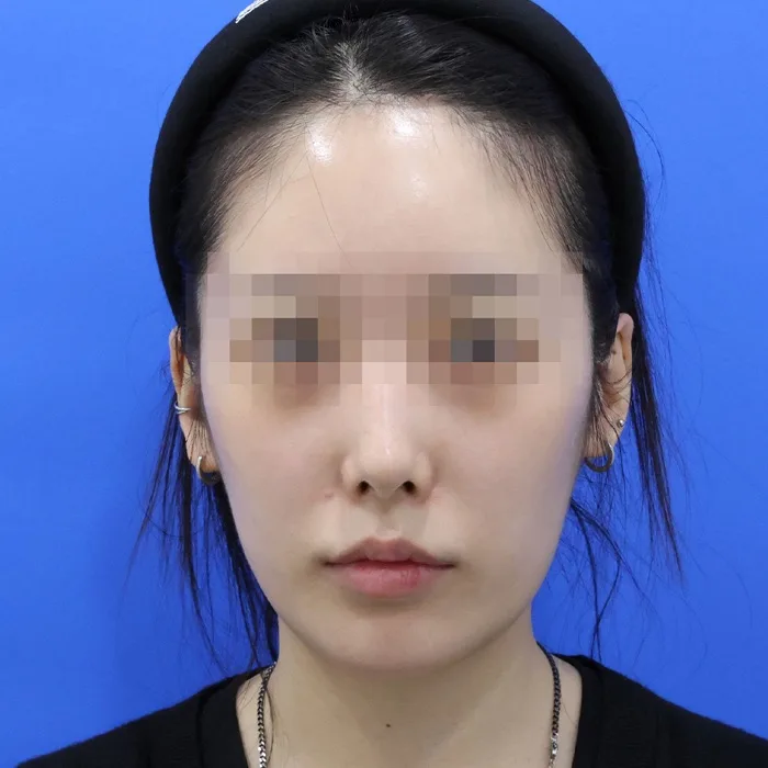 Trước khi điều trị — căng chỉ cố định lớp cân, ảnh chính diện