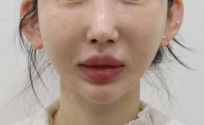 After — midface elevation with under-eye fat repositioning