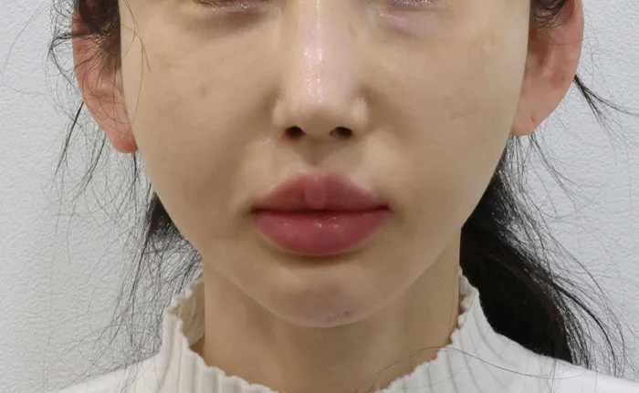 Before — midface elevation with under-eye fat repositioning