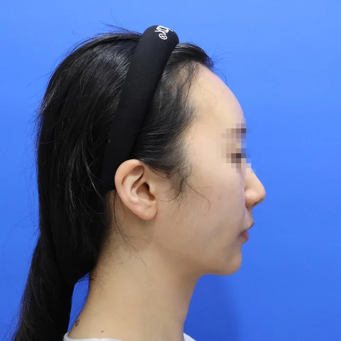 Sau điều trị — căng chỉ kèm xử lý cơ bám da cổ, ảnh nghiêng