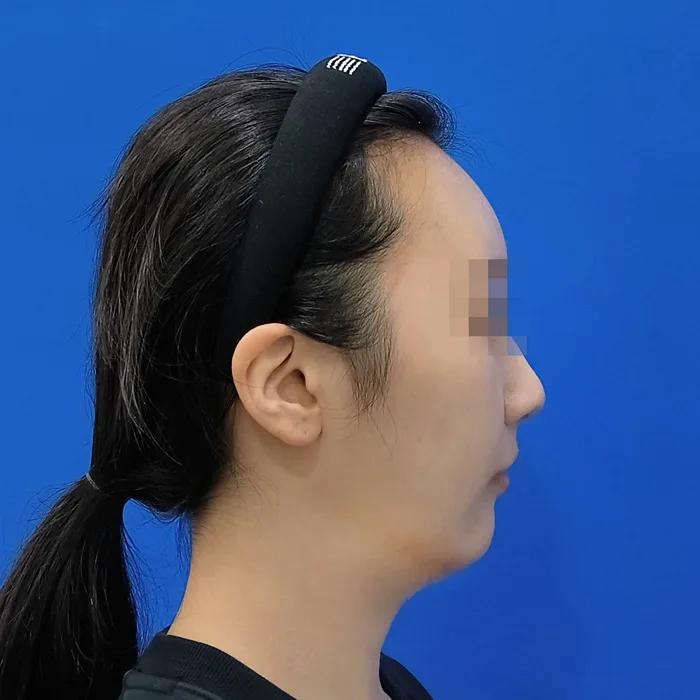 Trước khi điều trị — căng chỉ kèm xử lý cơ bám da cổ, ảnh nghiêng