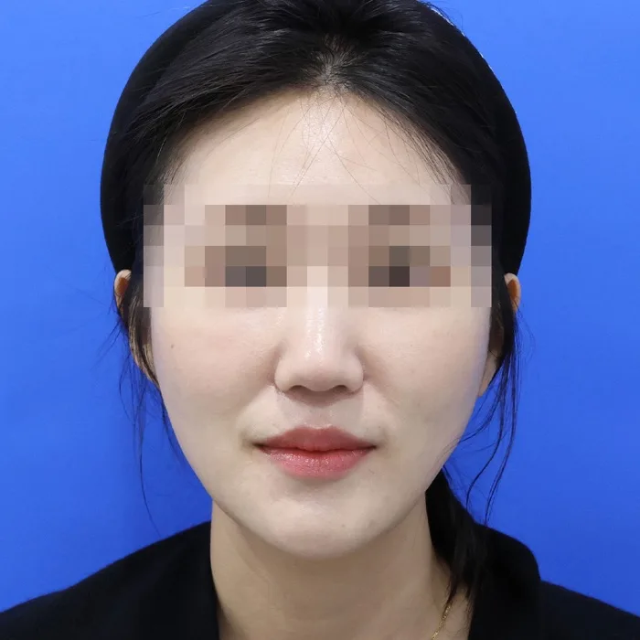 Sau điều trị — căng chỉ da mặt, ảnh chính diện