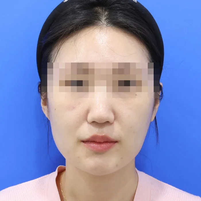 Trước khi điều trị — căng chỉ da mặt, ảnh chính diện