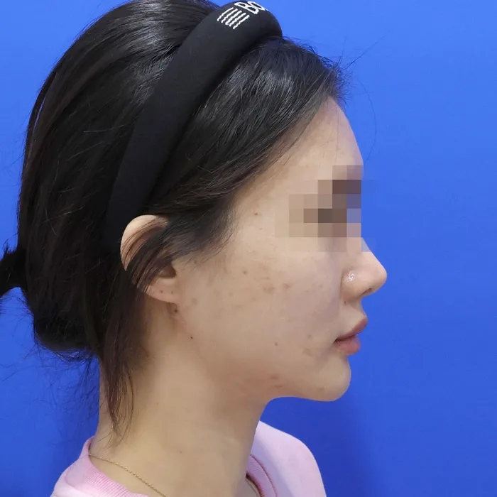 Sau điều trị — căng chỉ kèm hút mỡ nọng cằm và xử lý cơ bám da cổ, ảnh nghiêng